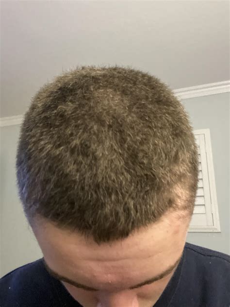 Best Receding Hairline Treatments & solutions
