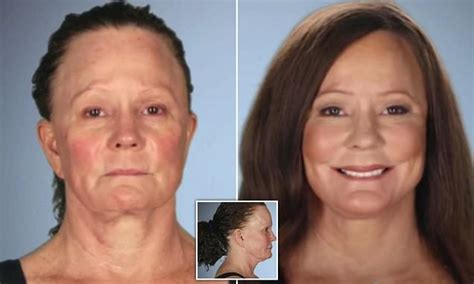 Mother Of Two Left With A Cobra Neck After A Botched Face Lift