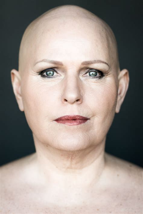 Baldvin I Photograph Women With Alopecia To Break Gender Stereotypes