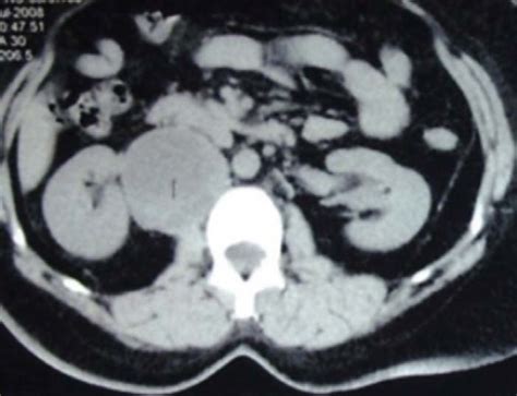 Ct Scan Of The Abdomen Showing Right Side Retroperitoneal Cystic Mass
