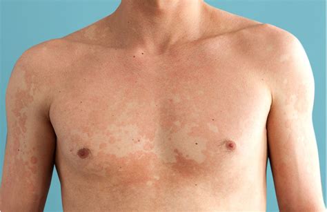 Tinea Versicolor Symptoms Causes And Treatment