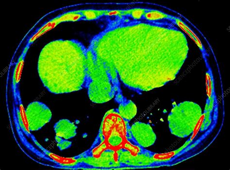 Cannonball Pulmonary Metastases Ct Scan Stock Image F0348221