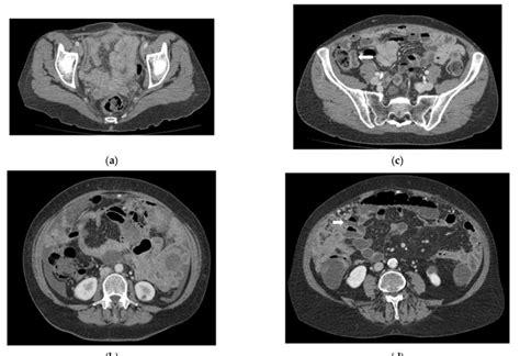 Ct Enterography For Preoperative Evaluation Of Peritoneal