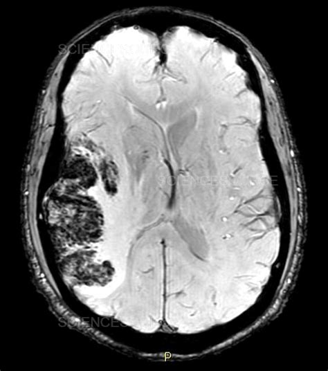 Photograph Hemorrhagic Cerebral Infarct Mri Science Source Images