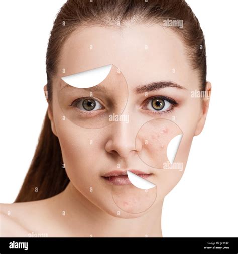 Circles With Acne Unstick From Healthy Skin Stock Photo Alamy