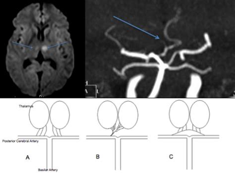Bilateral Thalamic Infarcts Due To Occlusion Of The Artery Of Percheron And Discussion Of The