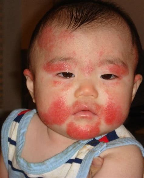 Red Rash On Baby Face Due To Allergic Reaction Baby Acne Baby Acne