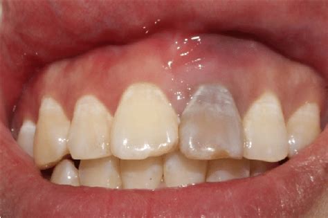 Discoloration Of Teeth After Trauma Download Scientific Diagram