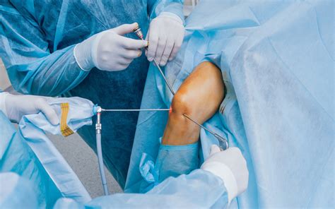 Knee Arthroscopy Changing Practice Insight