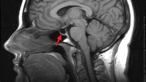 Bariatric Surgery Promising In Idiopathic Intracranial Hypertension