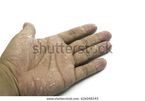 Hand Blister Allergic Reaction On Hand Stock Photo 626048543 Shutterstock