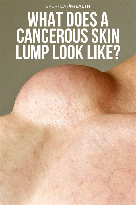 What Does A Cancerous Skin Lump Look Like Skin Epidermoid Cyst