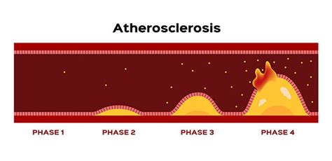 How To Keep Your Arteries Clean And Reverse Atherosclerosis Dr Mcdougall