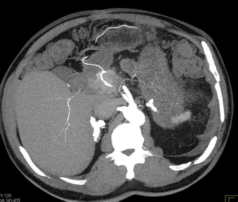 Bilateral Adrenal Calcification In Patient With Prior Hemorrhage
