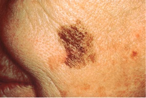 How To Detect Skin Cancer Minnesota Oncology