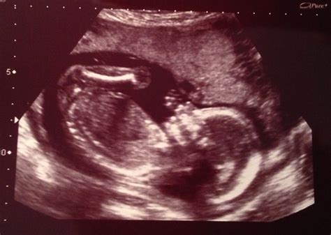 Baby Ultrasound Pics At 20 Weeks Idea Hostalelportalico