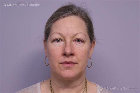 45 54 year old woman before and after microneedling treatment — md wellness solutions
