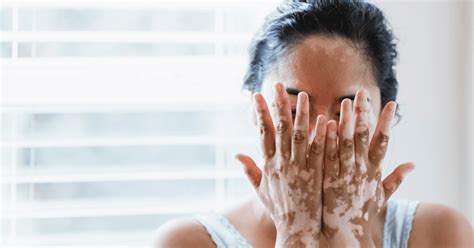 Treatment Over Cure For Vitiligo