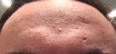 How To Deal With Bumpy Texture On Forehead Skincareaddiction