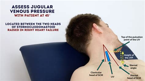 Jugular Venous Pressure Jvp Measurement Waveforms Geeky Medics