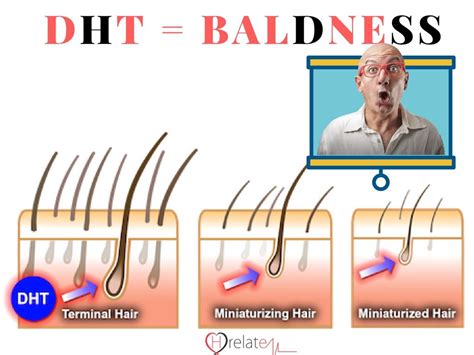 Vata, pitta, and kapha (biological energies in your body). How Does DHT Responsible For Baldness (Androgenic Alopecia ...