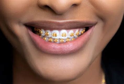 Gold Braces For Teeth Gold Vibes Only At Augusta Orthodontics