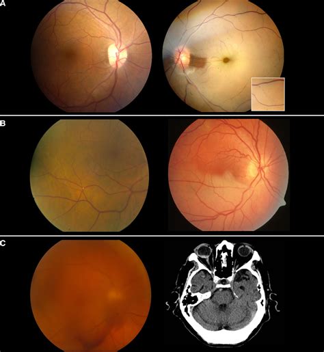 Thrombolytic Therapy For Acute Central Retinal Artery Occlusion Stroke