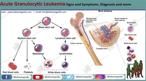Acute Granulocytic Leukemia Agl Symptoms Causes And More Lab Tests
