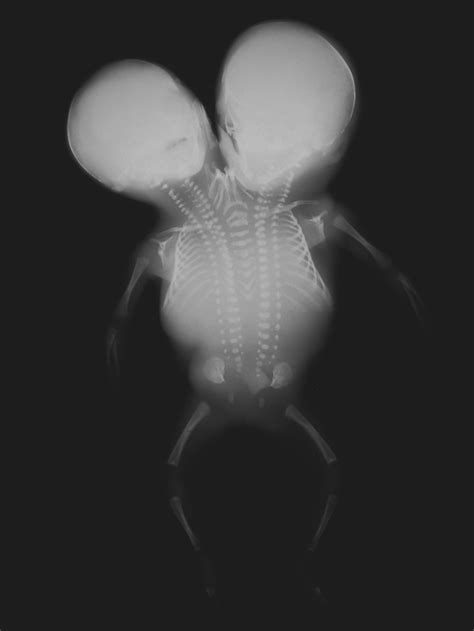 Conjoined Twins Postmortem X Ray Showing The Degree Of Skeletal Fusion