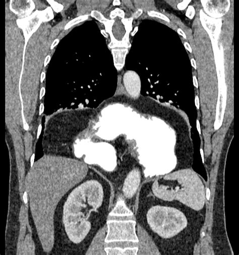 Hiatal Hernia Type Iv With Organoaxial Volvulus Image