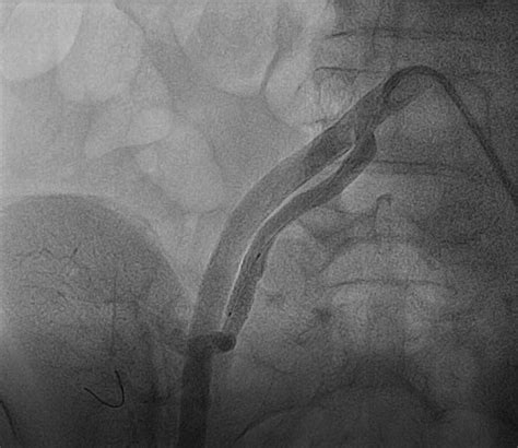 Renal Angiogram Showing Successful Angioplasty Done With Hippocampus