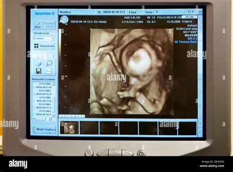 El Ultrasonido Obstétrico 3d De Un Feto 4d Baby Scan Que Muestran