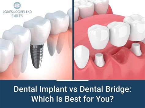 Dental Bridge Or Dental Implant Which Is Best For You