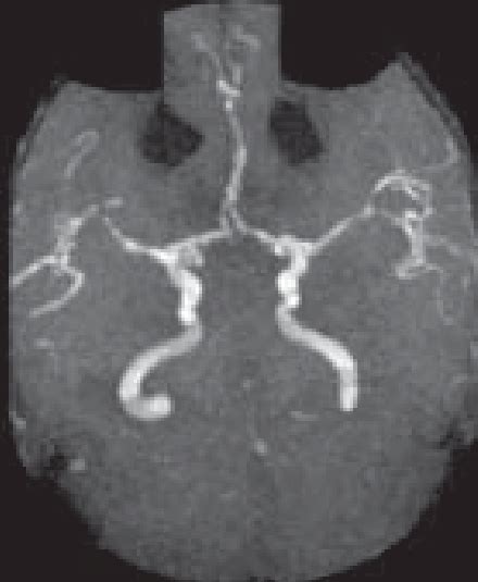 Mr Angiogram Showing Features Of Basilar Artery Thrombosis Anterior