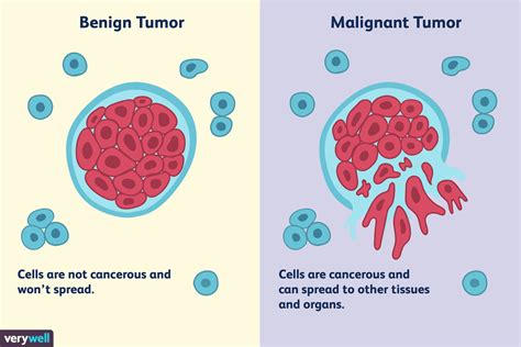 Diferença Entre Tumor Maligno E Benigno Yalearn