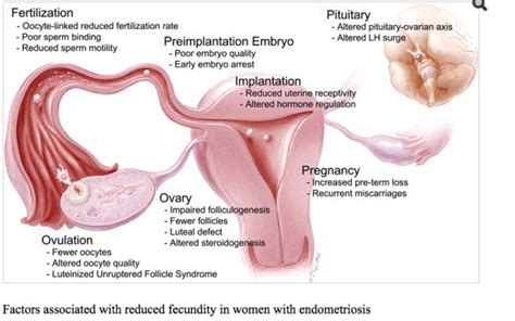 Endometriosis Infertility Endometriosis Immune System