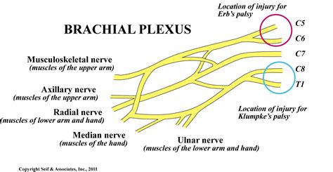 Shoulder Dystocia Brachial Plexus Injury