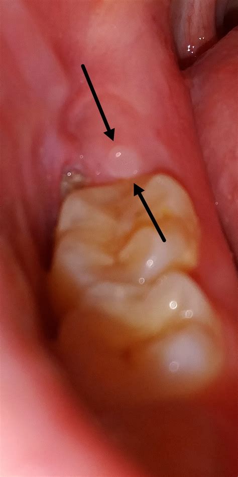 What Is This White Spot Ever Where My Wisdom Tooth Should Be R