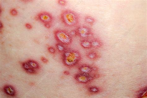 Skin Rash In Dermatomyositis Stock Image C0139703 Science Photo Library