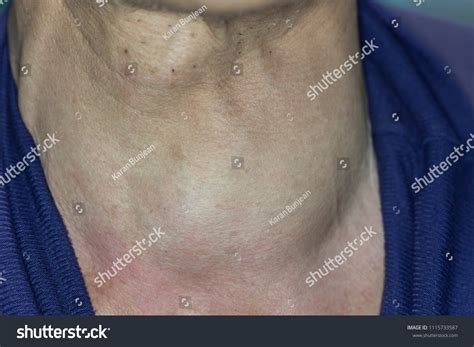 Zooming Closeup View Enlarged Thyroid Gland Stock Photo 1115733587