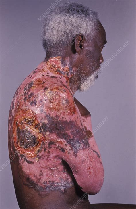 Infected Skin Cancer Stock Image M1310515 Science Photo Library