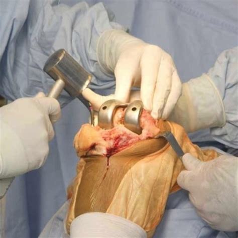 : Knee Replacement Surgery India