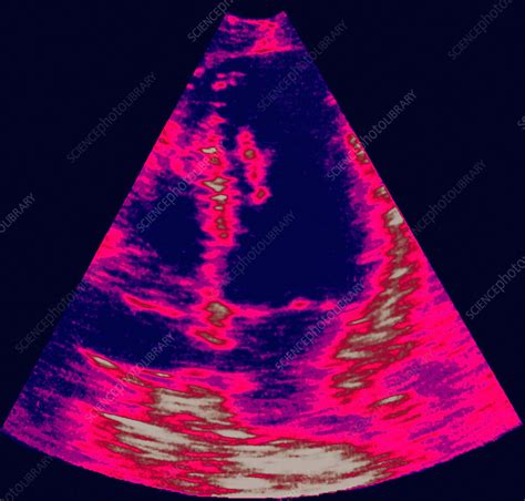 Heart Defect Ultrasound Scan Stock Image M1720625 Science Photo