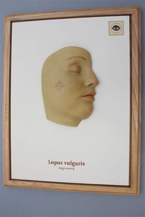Most people, however, need to continue treating their skin for life. Moulage, Lupus vulgaris beginnend (Gesicht/Wange), 34x26 ...