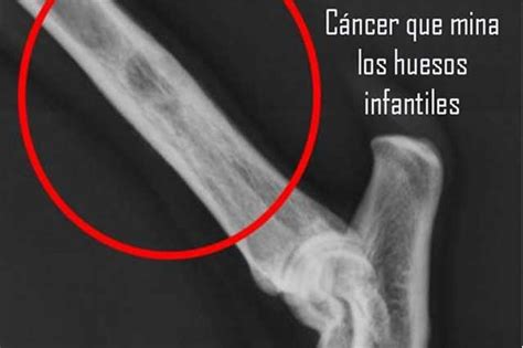 Osteosarcoma Un Cáncer Que Azota A Niños En México E
