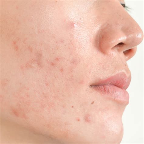 Dark Spots After Pimples Causes And Treatment Faqs