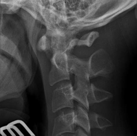 Jefferson Fracture Radiology Reference Article