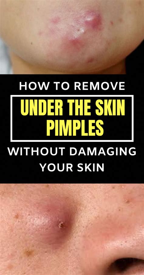 Pin By Mayra On Beauty In 2020 Pimples