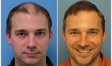 Surgical Hair Restoration What To Look For In A Surgeon
