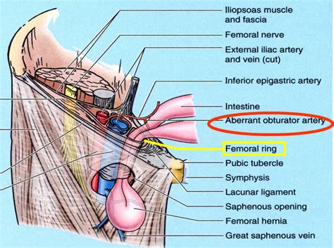 Anatomy Of Inguinal And Femoral Hernias Inguinal And Femoral Hernia